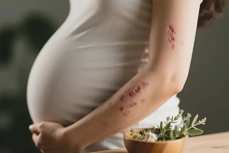 产妇身上容易长湿疹不管它会自己好吗(图1)