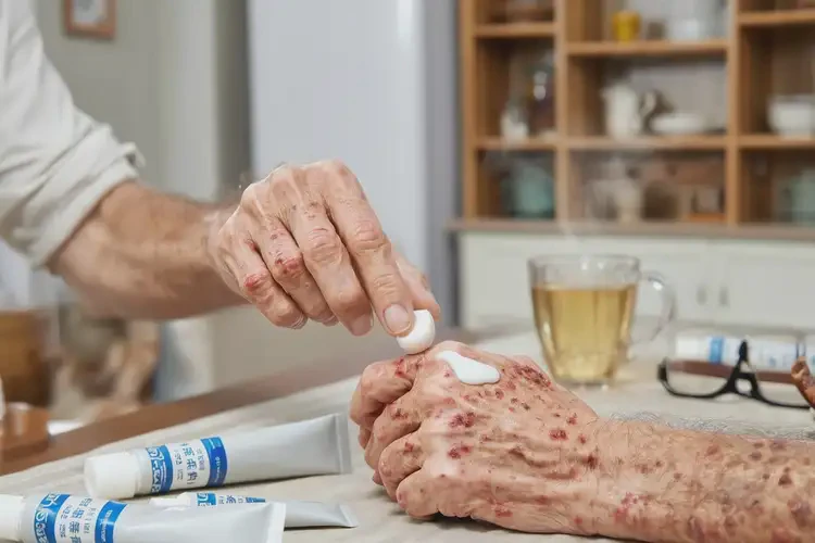 老人手上容易長濕疹不管它會自己好嗎(圖3)