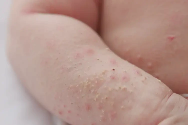 新生兒手臂上偶爾長(zhǎng)濕疹不管它會(huì)自己好嗎(圖4)