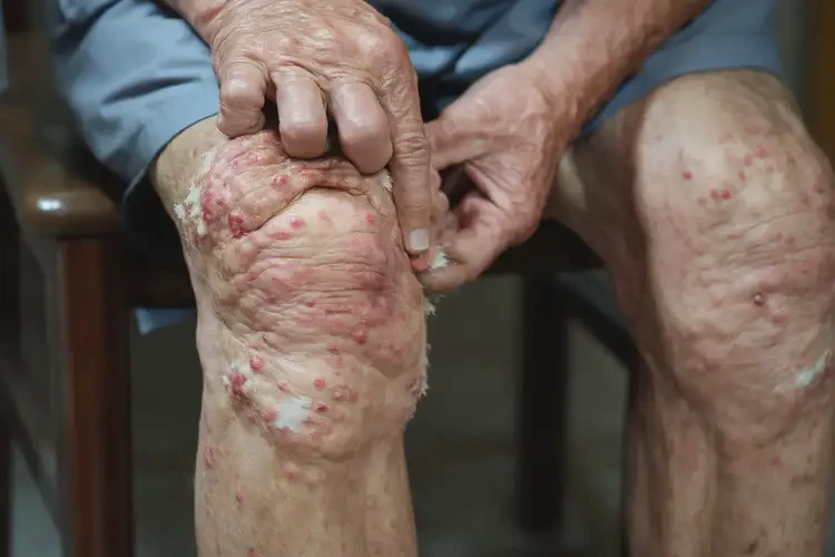 老年人大腿起濕疹可不可以徹底自愈(圖4)