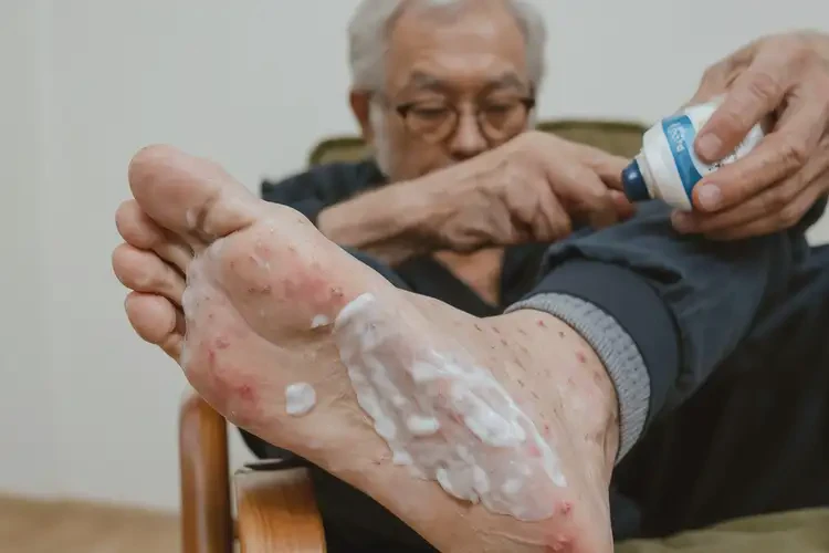 老年人腳上長濕疹不管它會自己自愈嗎(圖3)