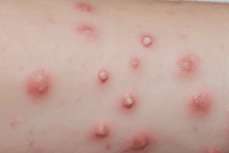 男生手臂容易起濕疹不管它會(huì)自己好嗎(圖4)