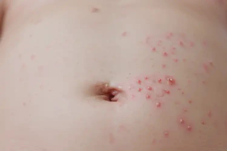 新生兒肚子上經(jīng)常起濕疹可以徹底自愈嗎(圖4)