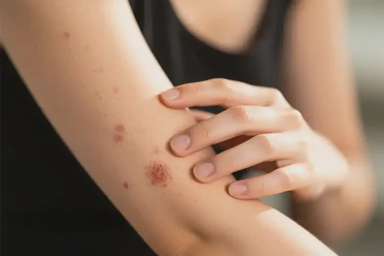 女性手臂偶爾長(zhǎng)濕疹不管它會(huì)自己痊愈嗎(圖3)