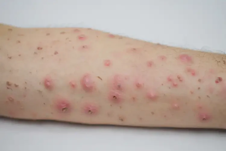 女人肚子偶爾起濕疹可以徹底自愈嗎(圖4)