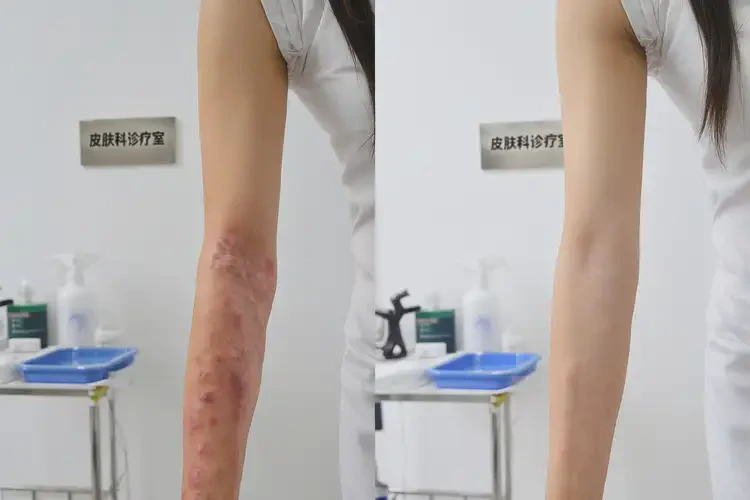 女性手臂有濕疹能徹底自愈嗎(圖2)