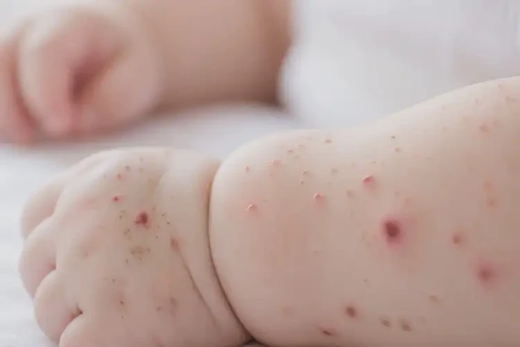 寶寶手上出現(xiàn)濕疹能靠自己自愈嗎(圖4)
