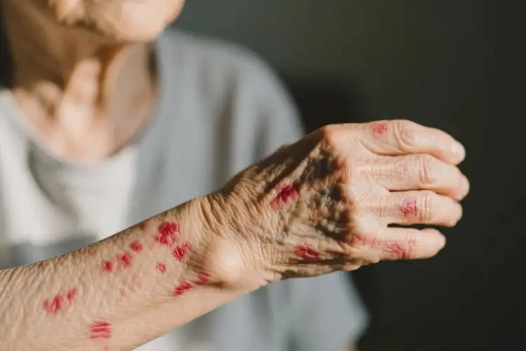 老人手臂經(jīng)常起濕疹能夠徹底治愈嗎(圖2)