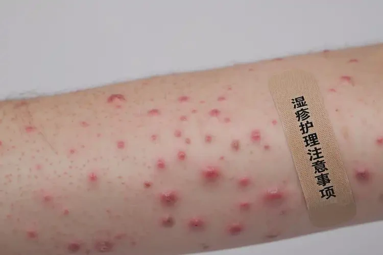 大學(xué)生手臂出現(xiàn)濕疹能不能徹底自愈(圖4)