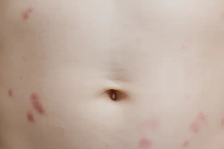 幼兒肚子偶爾起濕疹能不能徹底自愈(圖4)