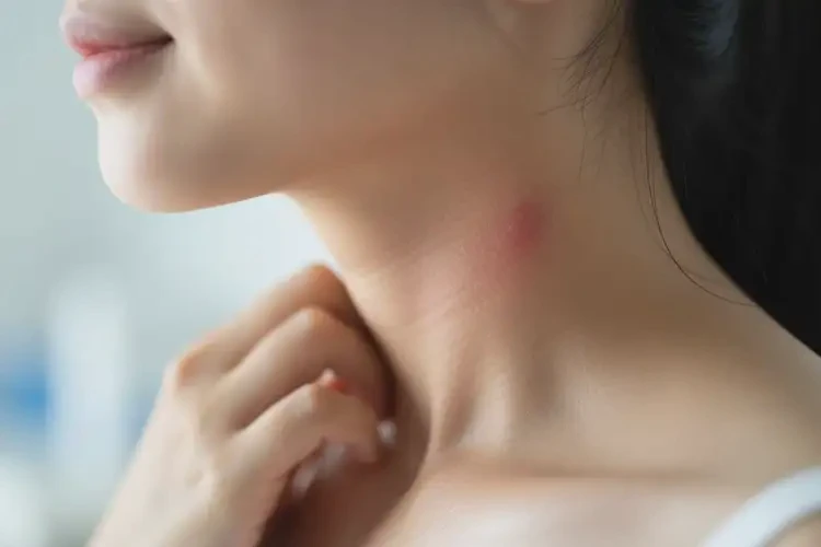 孕婦脖子出現(xiàn)濕疹可不可以徹底自愈(圖1)