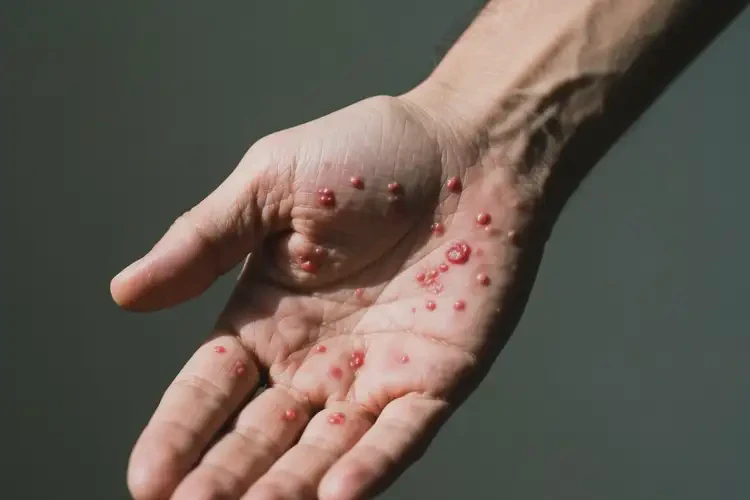 男人手臂上偶爾長濕疹不管它會(huì)自己自愈嗎(圖2)