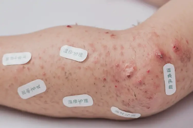 兒童四肢有濕疹能靠自己自愈嗎(圖4)