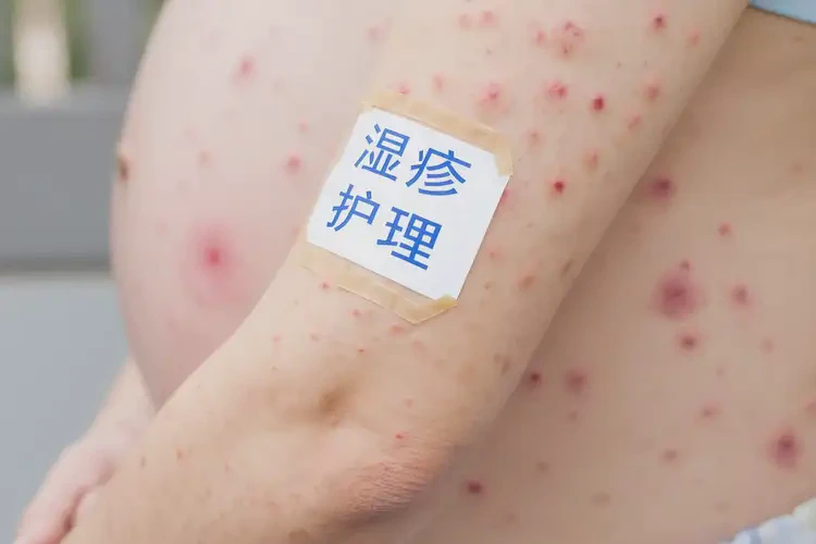孕妇手臂上经常起湿疹能靠自己自愈吗(图4)