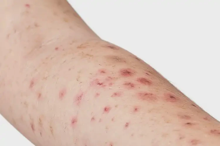 小孩脖子上有濕疹能夠徹底治愈嗎(圖4)