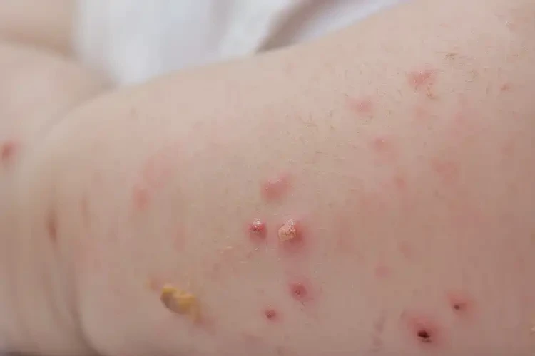 嬰幼兒全身起濕疹不管它會自己自愈嗎(圖4)