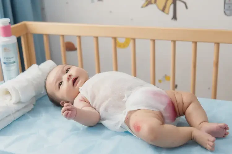 小孩屁股偶爾起濕疹能夠徹底治愈嗎(圖1)