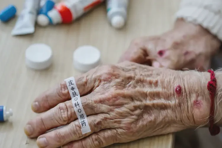 老人手上容易長濕疹不管它會自己好嗎(圖4)