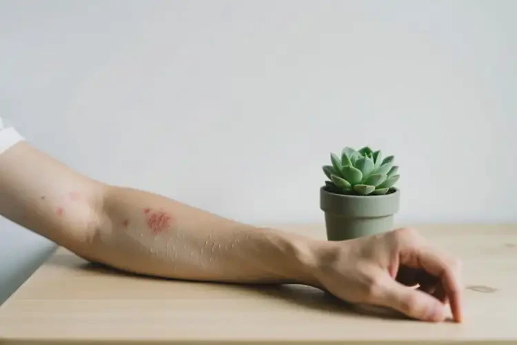 青年人手臂長濕疹可以徹底自愈嗎(圖4)