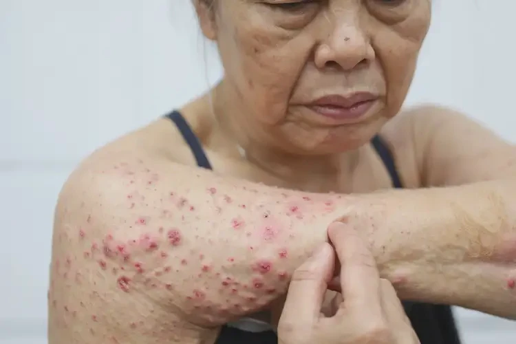 女性手臂偶爾長濕疹能徹底自愈嗎(圖4)