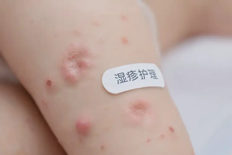 幼兒手臂上出濕疹能靠自己自愈嗎(圖4)