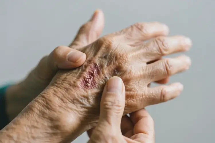 老年人手上有濕疹不管它會自己自愈嗎(圖2)