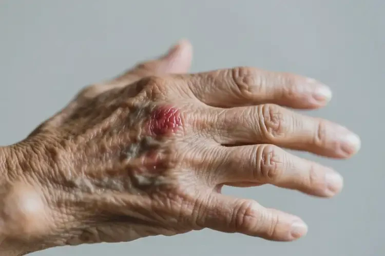 老人手上偶爾長(zhǎng)濕疹可不可以徹底自愈(圖3)