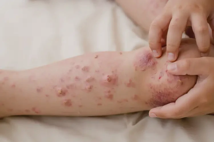 小兒大腿上長濕疹不管它會自己好嗎(圖3)