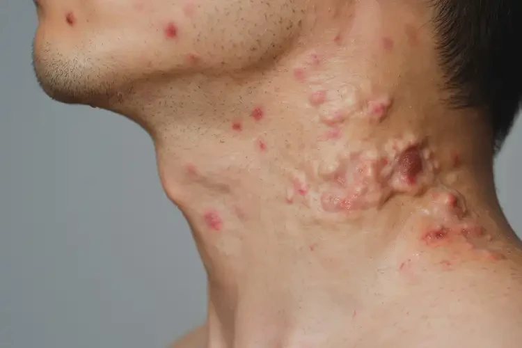 青年人脖子有濕疹不管它會(huì)自己自愈嗎(圖4)