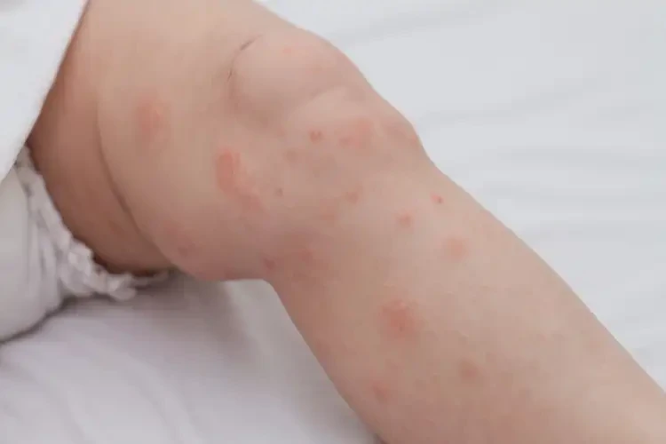 新生兒大腿經(jīng)常長濕疹可以徹底自愈嗎(圖4)