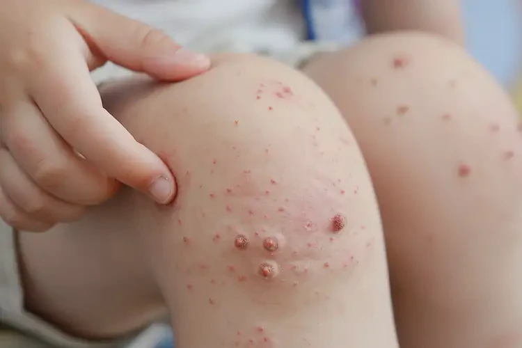 兒童大腿上經(jīng)常長(zhǎng)濕疹能夠徹底治愈嗎(圖4)