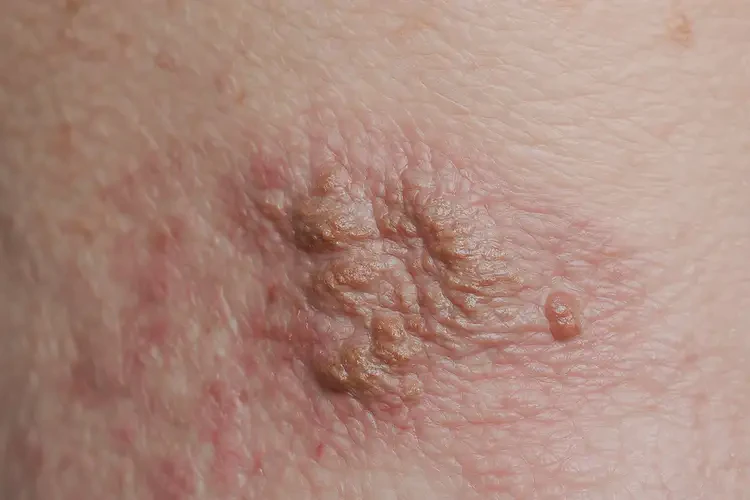 女生小腿起濕疹可不可以徹底自愈(圖2)