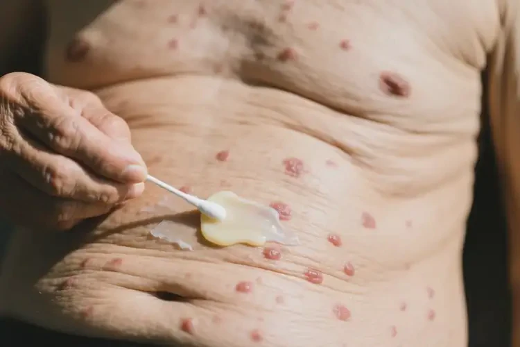 高齡老人肚子上有濕疹能徹底自愈嗎(圖2)