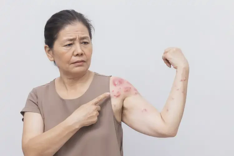 中学生肚子有湿疹能靠自己自愈吗(图4)