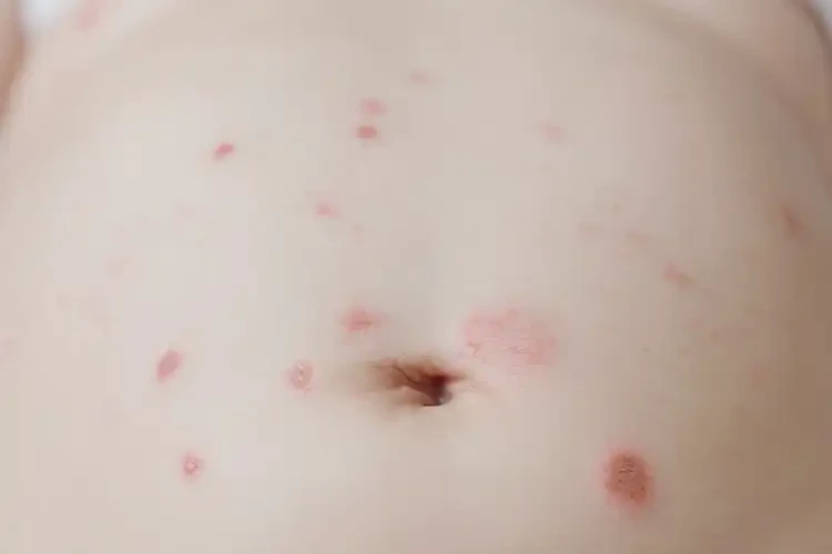 嬰兒肚子出現(xiàn)濕疹不管它會(huì)自己好嗎(圖4)