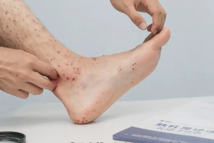 中學(xué)生腳上經(jīng)常起濕疹能徹底自愈嗎(圖4)
