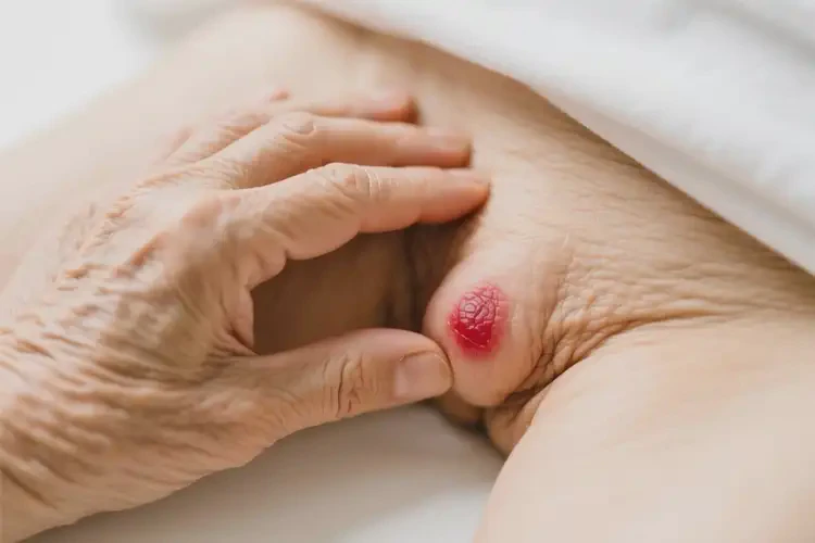 老年人肛周偶尔起湿疹不管它会自己痊愈吗(图3)