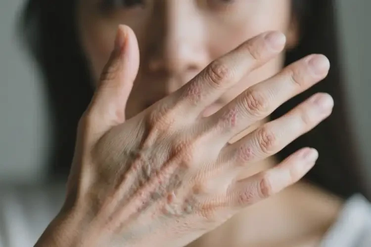女性手上有濕疹能靠自己自愈嗎(圖1)