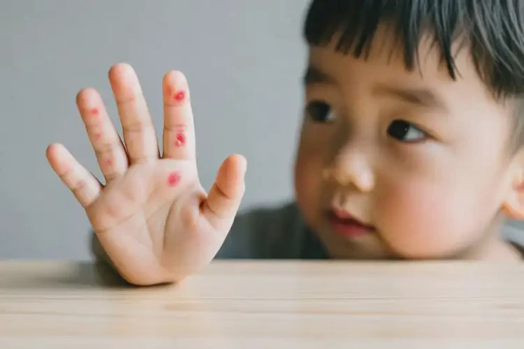 兒童手上出現(xiàn)濕疹不管它會(huì)自己自愈嗎(圖2)