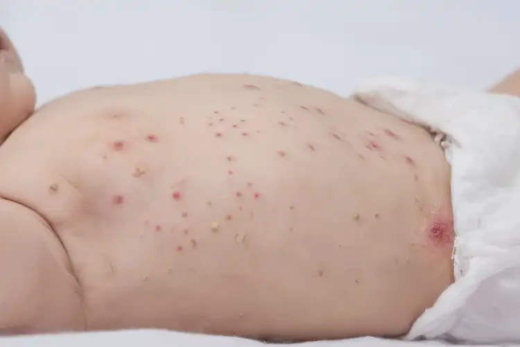 嬰幼兒肚子上經(jīng)常起濕疹能徹底自愈嗎(圖4)