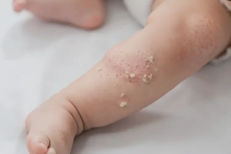 嬰幼兒小腿經(jīng)常長濕疹能徹底自愈嗎(圖3)