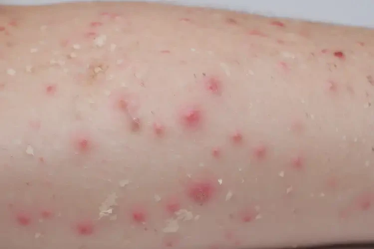 孩子身上出湿疹能够彻底治愈吗(图4)