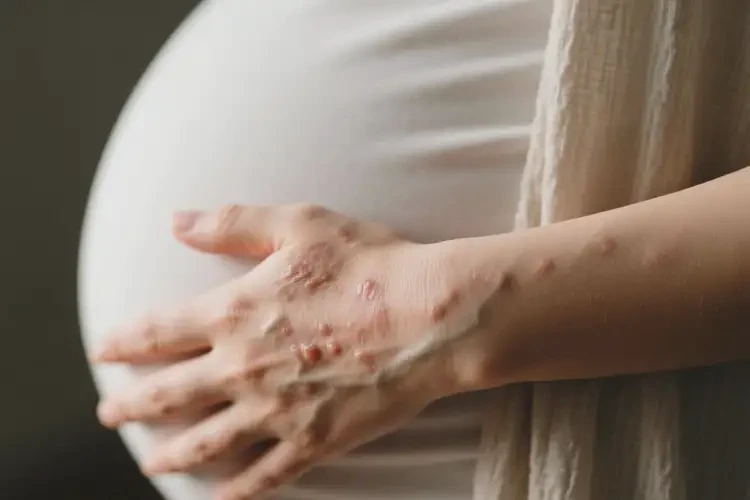 产妇身上容易长湿疹不管它会自己好吗(图4)