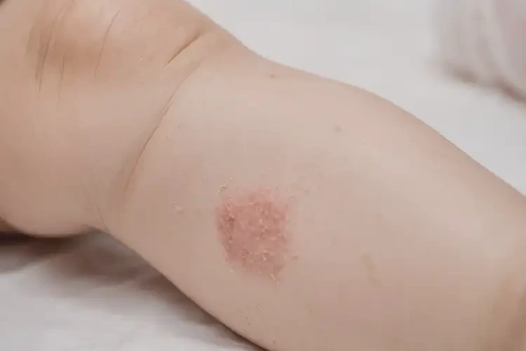 幼兒大腿上容易長濕疹不管它會自己痊愈嗎(圖4)