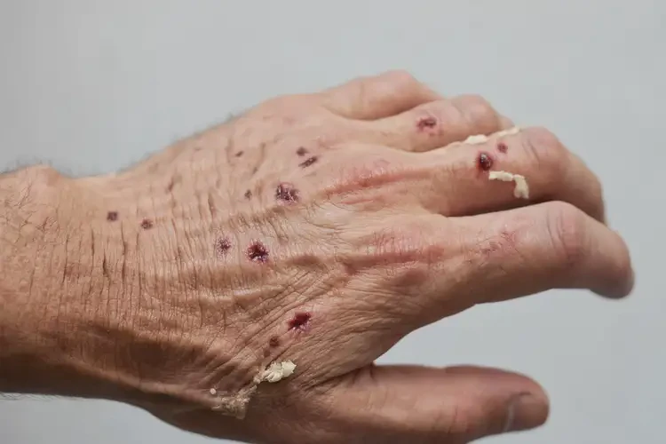 小學(xué)生手上長濕疹不管它會(huì)自己痊愈嗎(圖2)