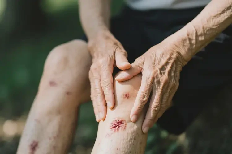 老年人四肢起濕疹不管它會(huì)自己好嗎(圖2)