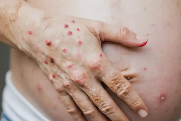 產(chǎn)婦手上長濕疹可不可以徹底自愈(圖4)