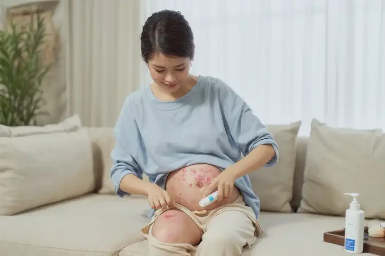 產(chǎn)婦大腿上偶爾起濕疹能靠自己自愈嗎(圖3)