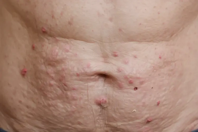 老年人肚子上容易長濕疹可不可以徹底自愈(圖4)