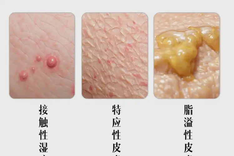 女人屁股有濕疹不管它會自己好嗎(圖1)